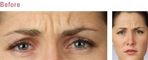frown  lines